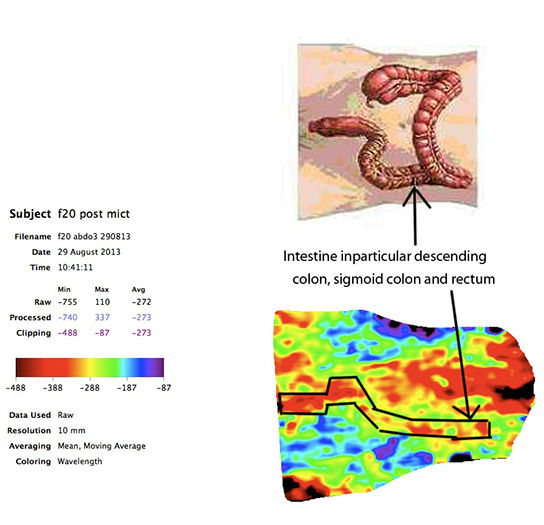 Large Intestine Scan