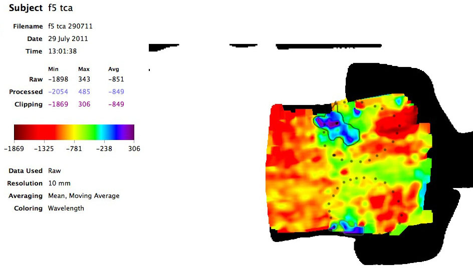 Cysts in Right Breast Scan