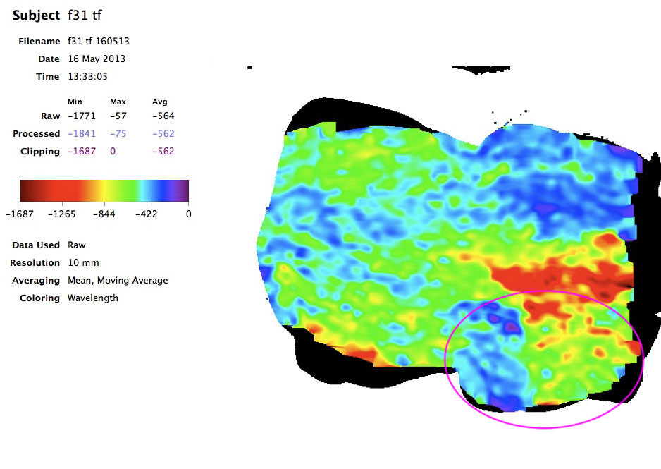 Breast Reconstruction Scan