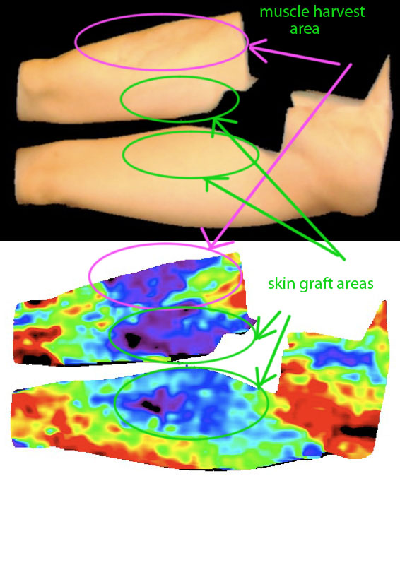 Scarring and Muscle Damage