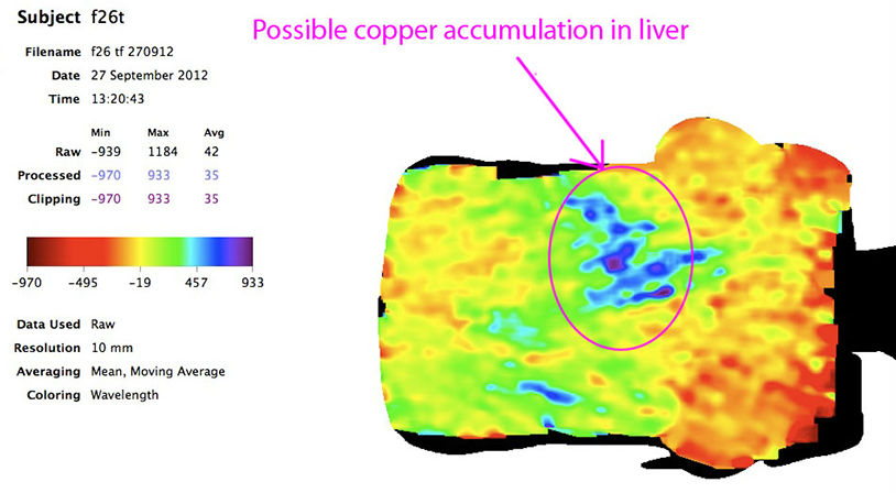 Wilson's Disease Liver Scan